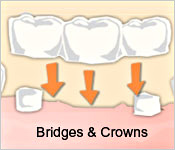implants-crowns-1