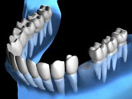 Dental Implant Dentists in Salem Oregon