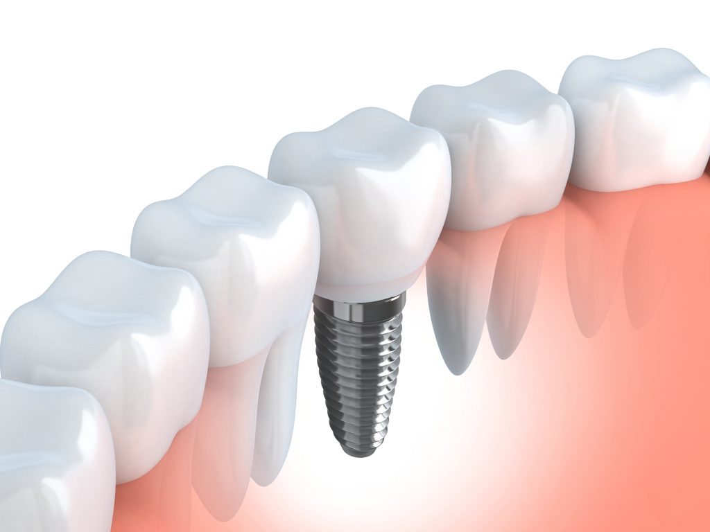 Dental Implants & Implant Dentistry in Salem Oreogn