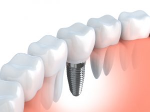 Dental Implant Dentist in Salem Oregon