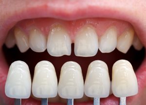 dentist color matching veneers on a patients teeth